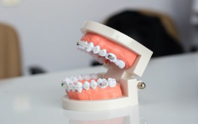 5 procedūras, kas iztaisno zobus