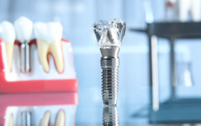 Kā zobu implanti uzlabo tavu ikdienu?