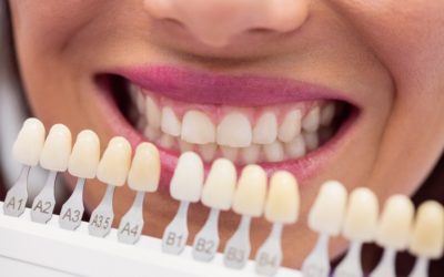 Kas ir zobu venīri un ko tie dara ar Jūsu dabīgajiem zobiem?